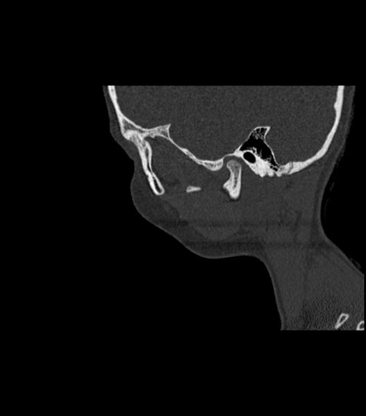 File:Nasoorbitoethmoid fracture (Radiopaedia 90044-107205 Sagittal bone window 31).jpg