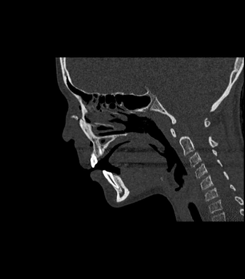 Nasoorbitoethmoid fracture (Radiopaedia 90044-107205 Sagittal bone window 66).jpg