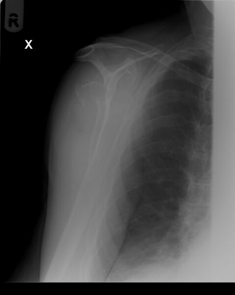 File:Neck of humerus fracture (Radiopaedia 8781-9582 B 1).jpg