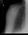 Neck of humerus fracture (Radiopaedia 8781-9582 B 1).jpg
