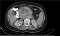 Necrotizing pancreatitis (Radiopaedia 20595-20495 Axial C+ delayed 15).jpg