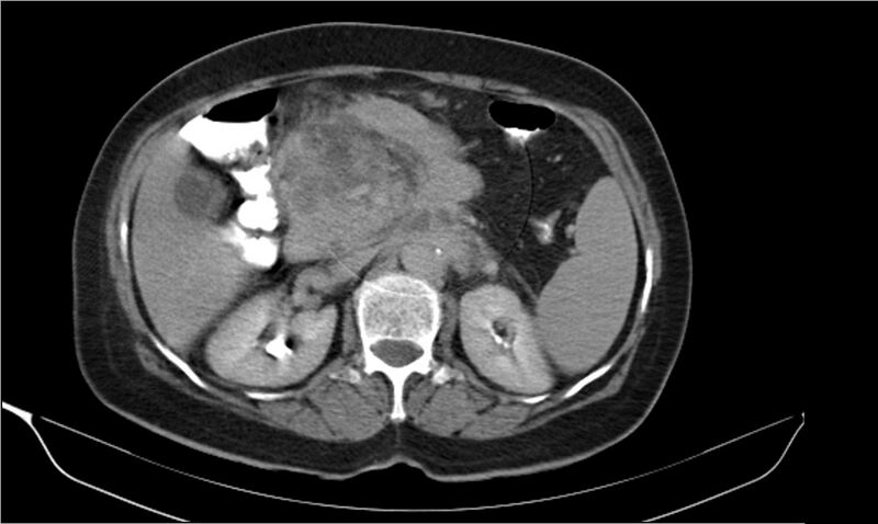 File:Necrotizing pancreatitis (Radiopaedia 20595-20495 Axial C+ delayed 15).jpg