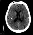 Neurocysticercosis (Radiopaedia 7773-8596 non-contrast 8).jpg