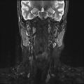 Neurofibromatosis type 1 (Radiopaedia 80355-93740 Coronal STIR 1).jpg