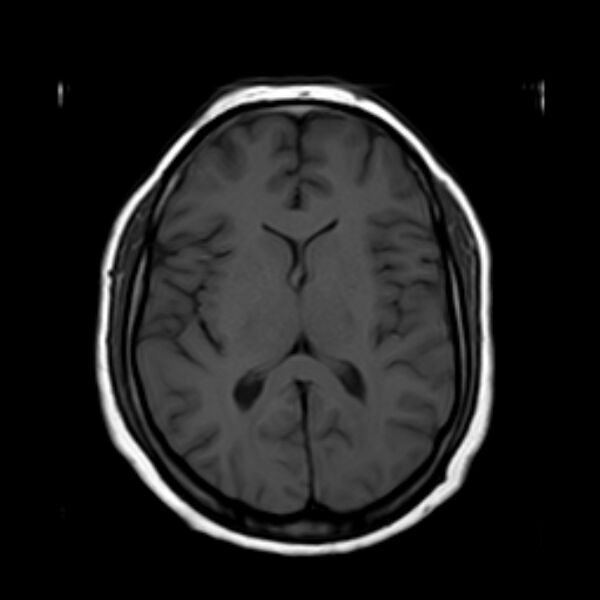 File:Neurofibromatosis type 2 (Radiopaedia 67470-76871 Axial T1 13).jpg