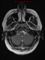 Neuroglial cyst (Radiopaedia 10713-11184 Axial T2 20).jpg