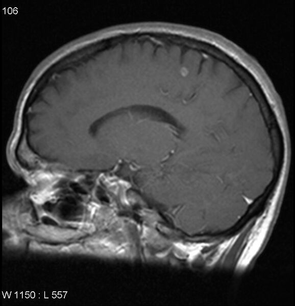 File:Neurosarcoidosis (Radiopaedia 10930-17204 Sagittal T1 C+ 11).jpg