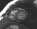 Non-compaction of the left ventricle (Radiopaedia 69436-79314 Short axis cine 78).jpg