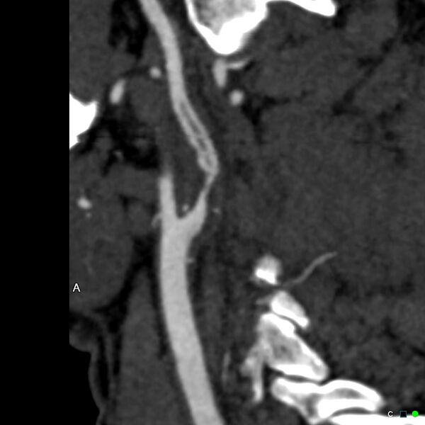 File:Non-occlusive intraluminal internal carotid artery thrombus (Radiopaedia 37751-39658 A 58).jpg