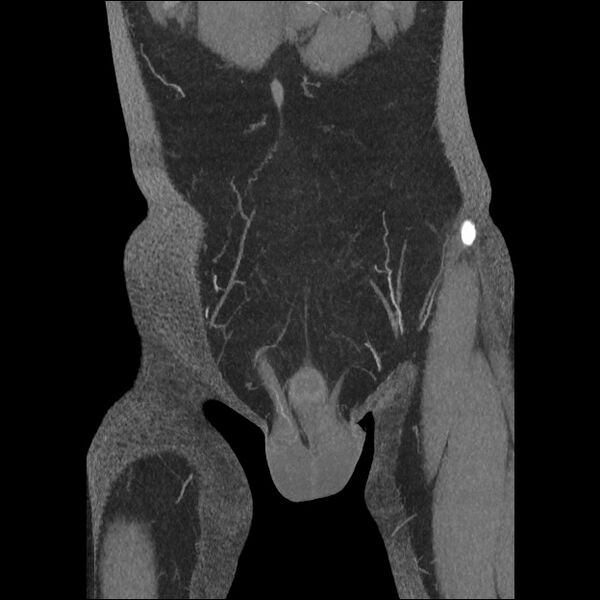 File:Normal CT angiogram of pelvis (Radiopaedia 45390-49430 B 11).jpg