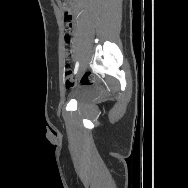 File:Normal CT angiogram of pelvis (Radiopaedia 45390-49430 C 45).jpg