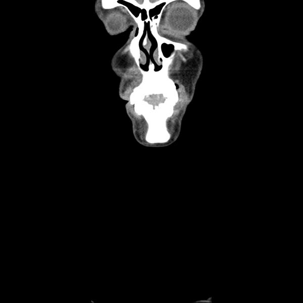 File:Normal CT of the neck (Radiopaedia 14575-14500 Coronal C+ 3).jpg