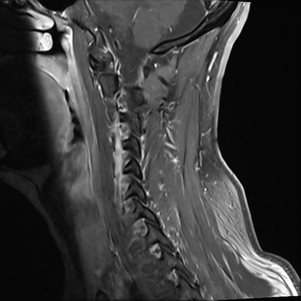 File:Normal MRI cervical spine (infection protocol) (Radiopaedia 53916-60039 I 11).png