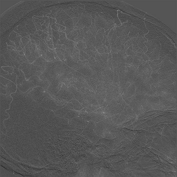 File:Normal cerebral angiogram (four vessel DSA) (Radiopaedia 41708-44649 F 13).png