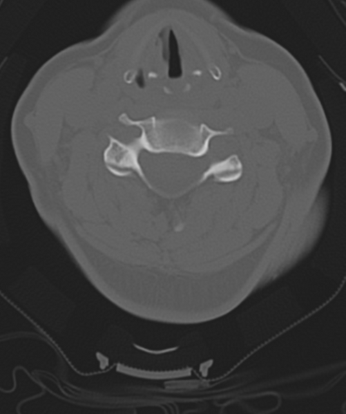 File:Normal cervical spine MRI (including Dixon) (Radiopaedia 42762-45926 Axial bone window 32).png