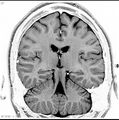 Normal coronal brain (Radiopaedia 6676-7910 B 27).jpg