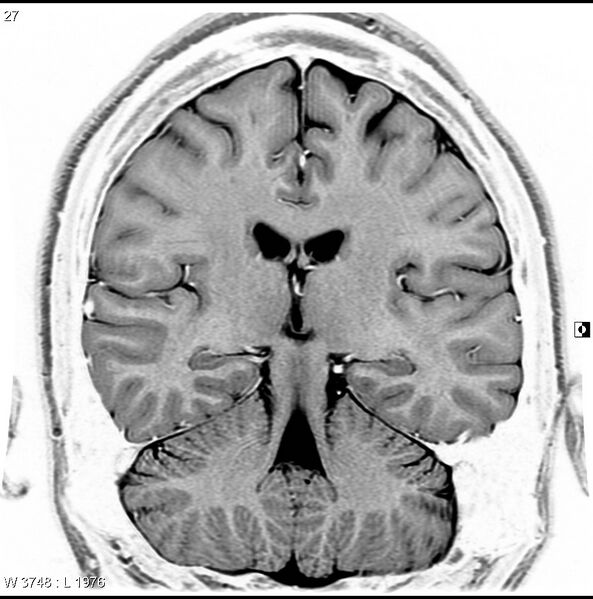 File:Normal coronal brain (Radiopaedia 6676-7910 B 27).jpg