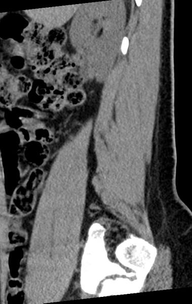 File:Normal lumbar spine CT (Radiopaedia 46533-50986 C 87).png