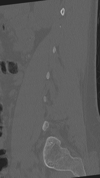 File:Normal lumbar spine CT (Radiopaedia 46533-50986 Sagittal bone window 76).png