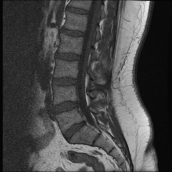 File:Normal lumbar spine MRI (Radiopaedia 43051-46311 Sagittal T1 11).jpg