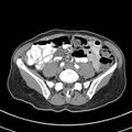 Normal multiphase CT liver (Radiopaedia 38026-39996 B 61).jpg