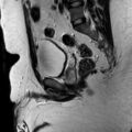Normal prostate (MRI) (Radiopaedia 29986-30535 Sagittal T2 14).jpg
