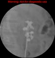 Normal retrograde pyelography of a native and transplant kidney (Radiopaedia 40480-43054 Native kidney 4).jpg