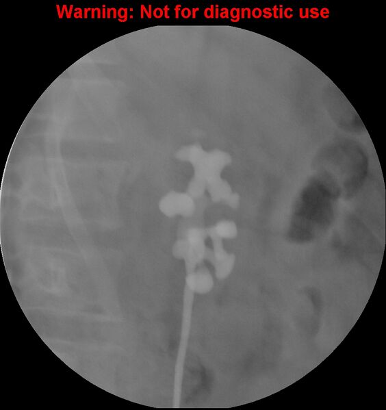 File:Normal retrograde pyelography of a native and transplant kidney (Radiopaedia 40480-43054 Native kidney 4).jpg