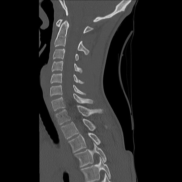 File:Normal trauma spine imaging (age 16) (Radiopaedia 45335-49358 Sagittal bone window 21).jpg