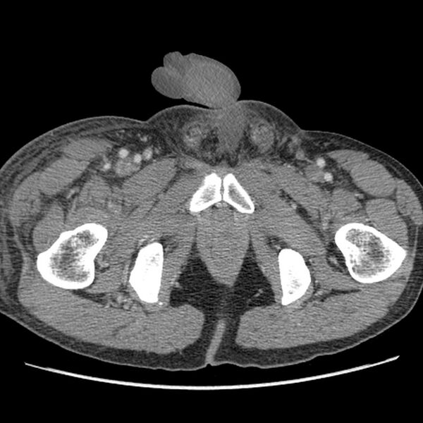 File:Obstructive bladder transitional cell carcinoma (Radiopaedia 9825-10410 A 38).jpg