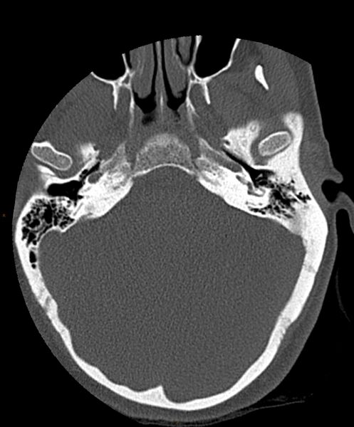 File:Occipital condyle fracture (Radiopaedia 61165-69056 D 2).jpg