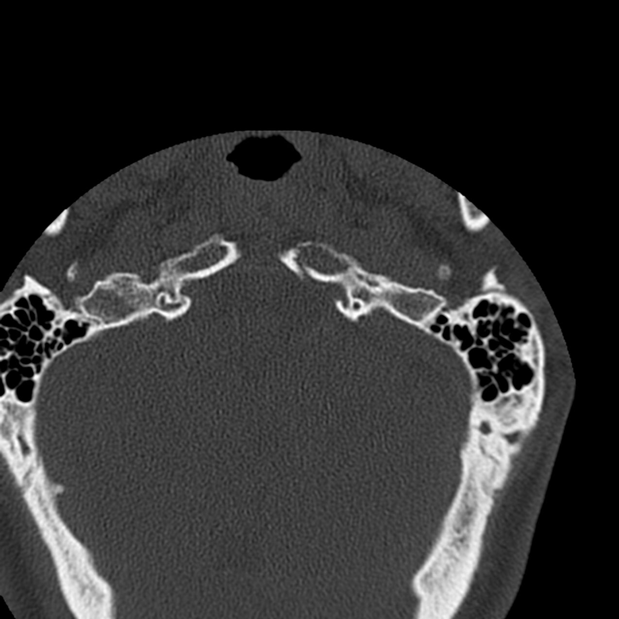Occipital Condyle Fracture Radiopaedia 31755 32691 Axial Bone Window Nc Commons 7578