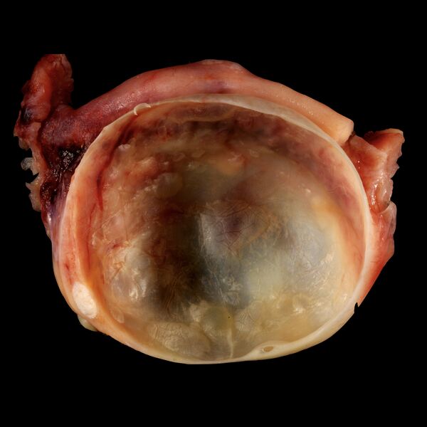 File:Ovarian cyst (gross pathology) (Radiopaedia 77477).jpeg