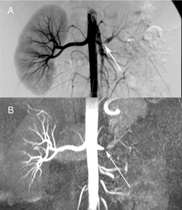 Comparison a) Digital subtraction arteriography and b) Unenhanced Magnetic resonance angiography of suboclusive left renal artery stenosis arrows