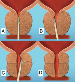 Prostatic urethral lift.png