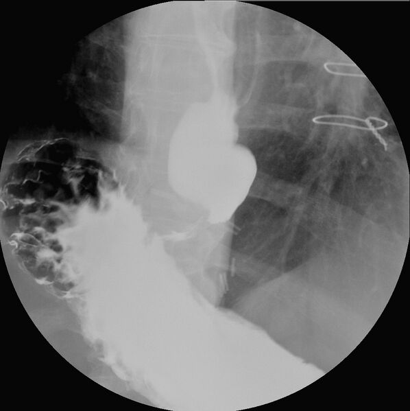 File:"Ballooning" of the distal esophagus after Heller myotomy (Radiopaedia 38485-40572 Prone (AP) 1).jpg