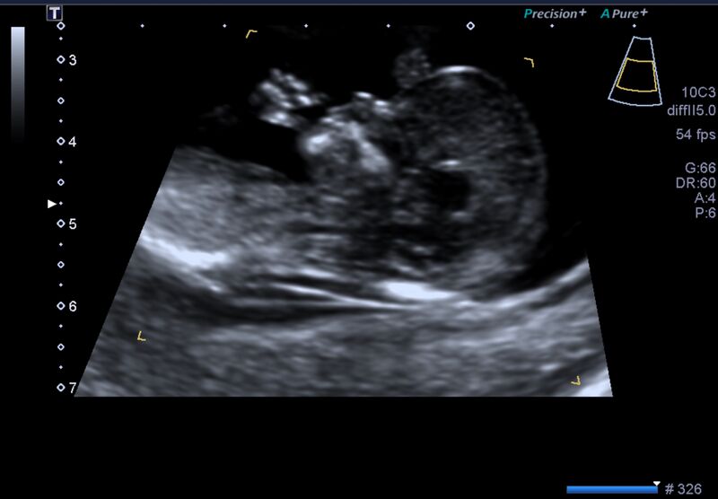File:1st trimester nuchal-morphology ultrasound (Radiopaedia 44706-48477 General anatomy and NT 28).jpg