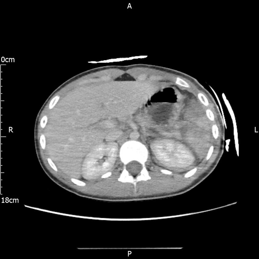 AAST grade IV kidney injury with CEUS follow-up (Radiopaedia 72353-82877 Axial C+ portal venous phase 17).jpg