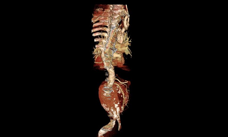 File:Abdominal aortic aneurysm- extremely large, ruptured (Radiopaedia 19882-19921 3D 15).jpg