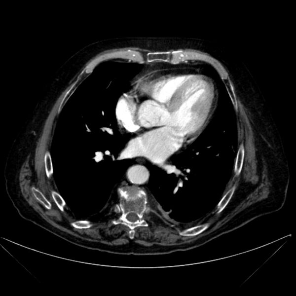 File:Abdominal aortic aneurysm (Radiopaedia 25855-26001 Axial C+ arterial phase 4).jpg