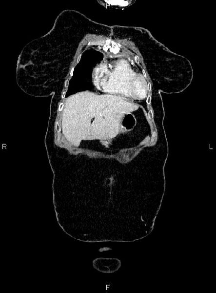 File:Abdominal aortic aneurysm (Radiopaedia 85063-100606 Coronal C+ arterial phase 1).jpg