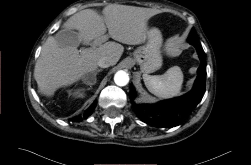 File:Abdominal aortic interposition tube graft and aneurysm thrombosis (Radiopaedia 71438-81857 Axial C+ arterial phase 3).jpg