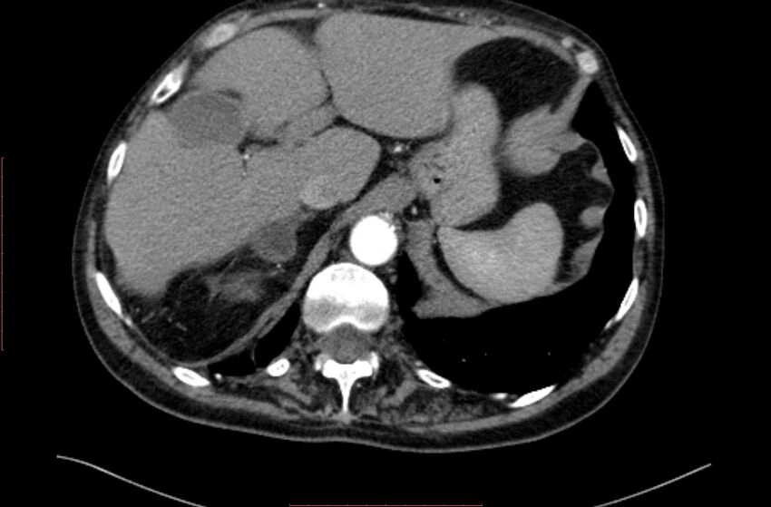 Abdominal aortic interposition tube graft and aneurysm thrombosis (Radiopaedia 71438-81857 Axial C+ arterial phase 3).jpg