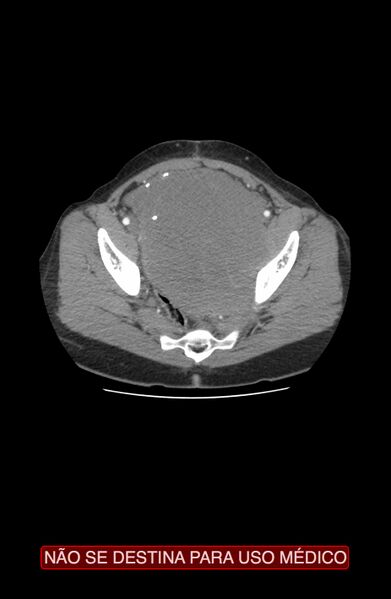 File:Abdominal desmoid tumor (Radiopaedia 44024-47540 Axial C+ arterial phase 41).jpg