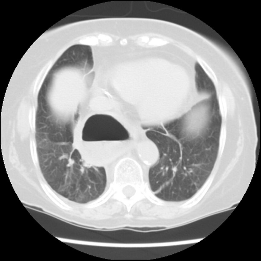 Achalasia (Radiopaedia 44094-47649 Axial lung window 43).jpg