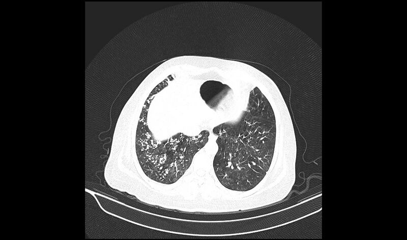 File:Acquired tracheo-esophageal fistula (Radiopaedia 51356-57103 Axial lung window 33).jpg