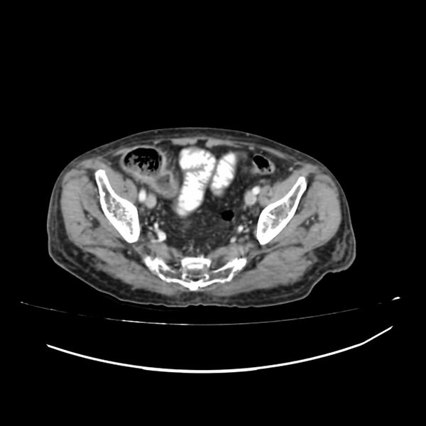 File:Acute-on-chronic Crohn disease with enteroenteric fistula (Radiopaedia 66686-75987 B 63).jpg