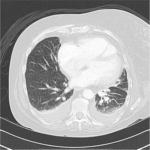 File:Acute-on-chronic pulmonary emboli (Radiopaedia 27925-28169 lung window 31).jpg