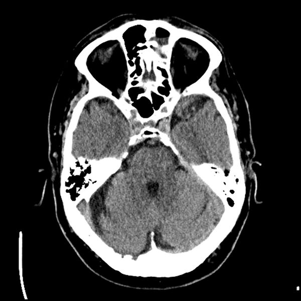 File:Acute A3 occlusion with ACA ischemic penumbra (CT perfusion) (Radiopaedia 72036-82525 Axial non-contrast 13).jpg
