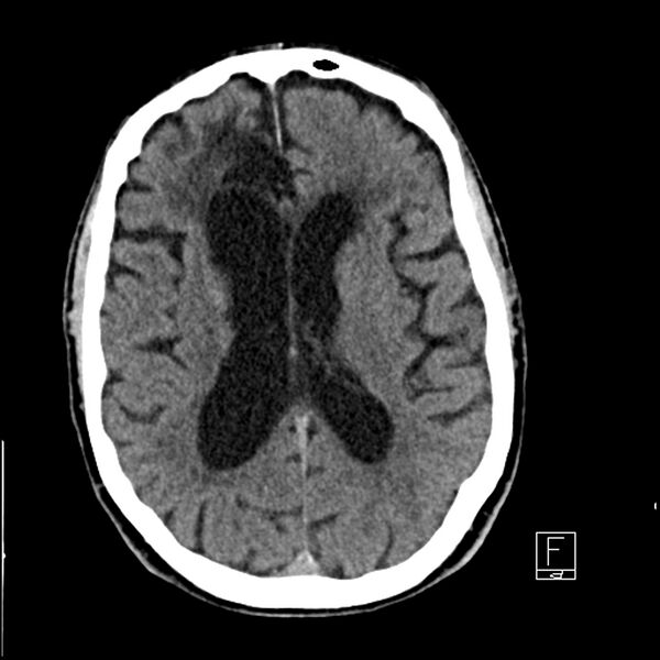 File:Acute ICA ischemic penumbra due to high-grade CCA stenosis (CT perfusion) (Radiopaedia 72038-82529 Axial non-contrast 27).jpg